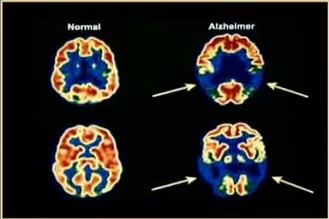 Le cannabis: defenseur des neurones