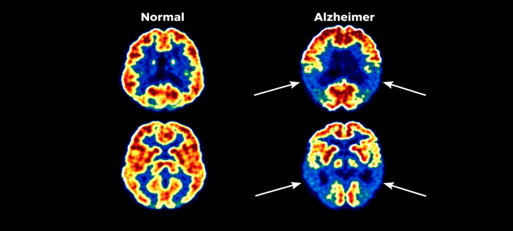 comparison of a normal brain and an Alzheimer’s brain