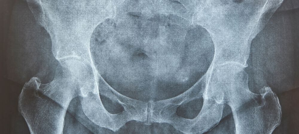 osteoporosis symptoms
